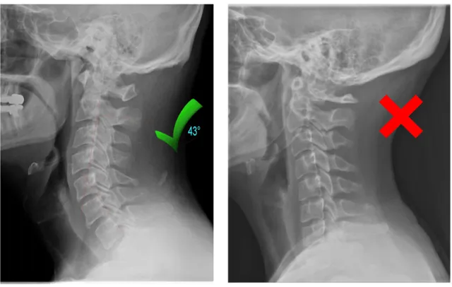 Your Neck Has Lost Its Natural Curve